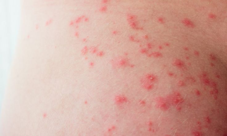 تعقيم جدري القرود